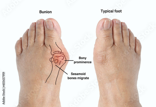 Closeup inflammation of deform bunion joint in big toe bone. Hallux valgus, bunion in female foot compare with typical foot isolated on white background. photo