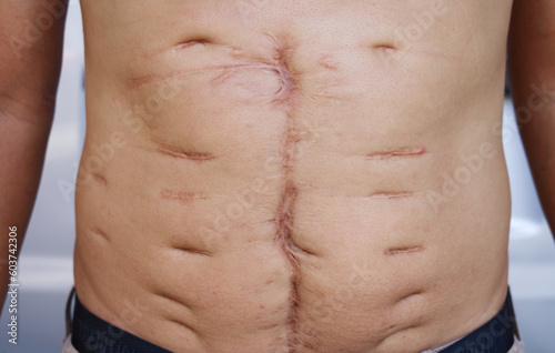 A large scar on the skin of an Asian man's abdomen was caused by major surgery, The longitudinal convex scar is a scratch from the stitches, The body suffered a large wound from hospital treatment.