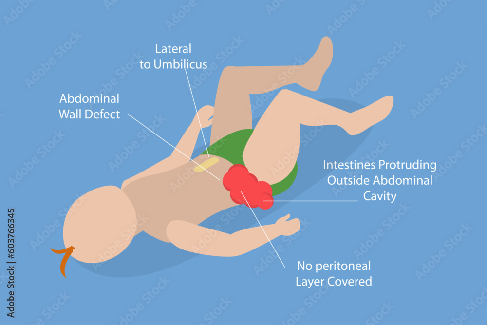 3D Isometric Flat Vector Conceptual Illustration of Gastroschisis, Abdominal Pain Belly Button