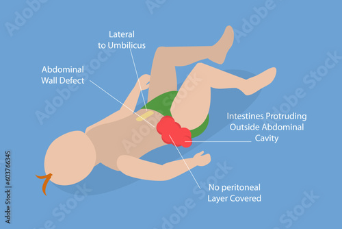 3D Isometric Flat Vector Conceptual Illustration of Gastroschisis, Abdominal Pain Belly Button photo