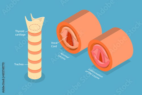 3D Isometric Flat Vector Conceptual Illustration of Laryngitis, Voice Disorder