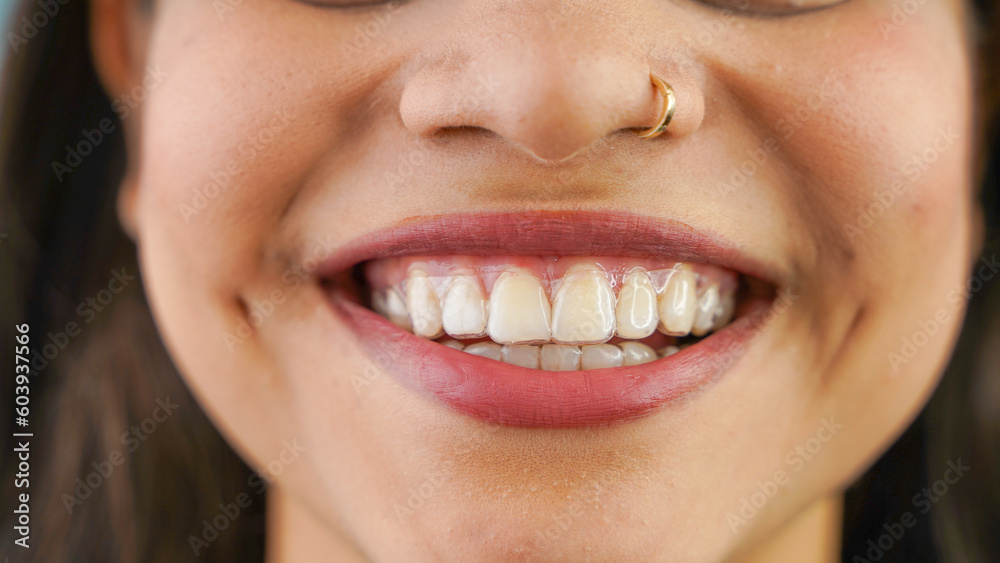 Young Asian Indian woman holding removable invisible aligner, also known as invisalign or clear aligner Young Asian Indian woman holding removable invisible aligner, also known as invisalign or clear aligner