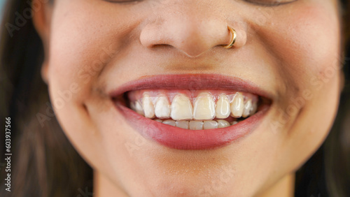 Young Asian Indian woman holding removable invisible aligner, also known as invisalign or clear aligner