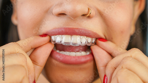 Young Asian Indian woman holding removable invisible aligner, also known as invisalign or  clear aligner