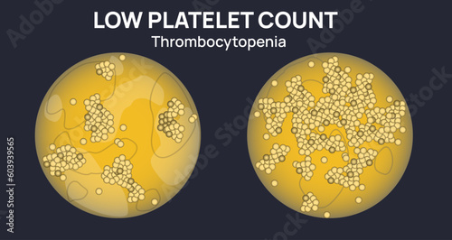 Low platelet counts on microscope colorful view illustration. lower than 150000 is thrombocytopenia. It cause internal bleeding and bruising. Thrombocytes and medications.