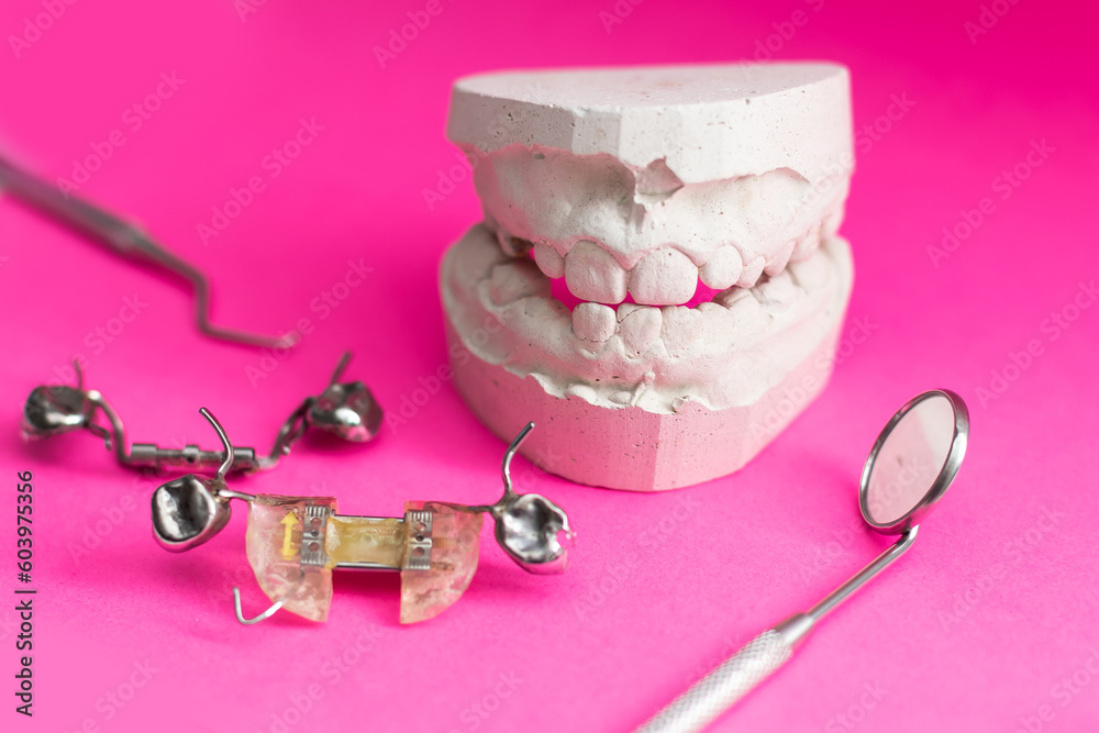 Dental models top view. Jaw models with different problems. Treatment