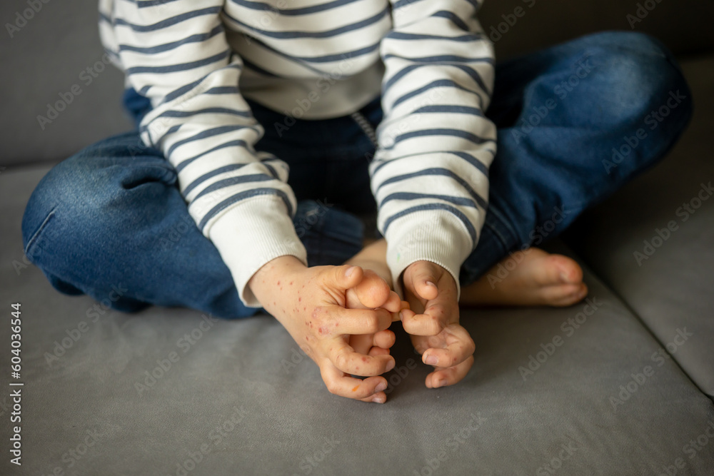 Child with skin rash, roseola. Handfootandmouth disease. Enterovirus