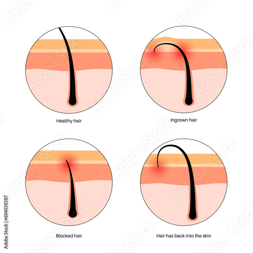Ingrown hair inflammation