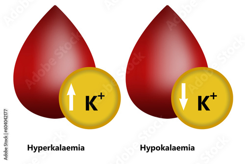Hyperkalaemia and Hypokalaemia with blood shape photo