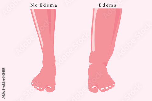 comparation of normal foot and edema foot, flat illustration for education. abnormal foot. vector eps 10