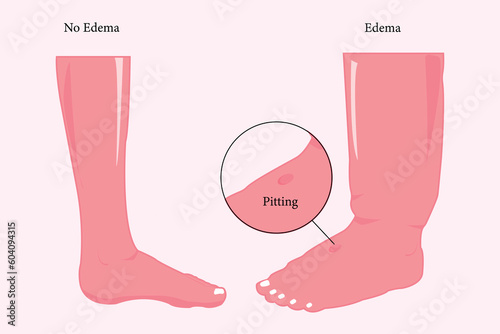 comparation of normal foot and edema foot, flat illustration for education. eps 10