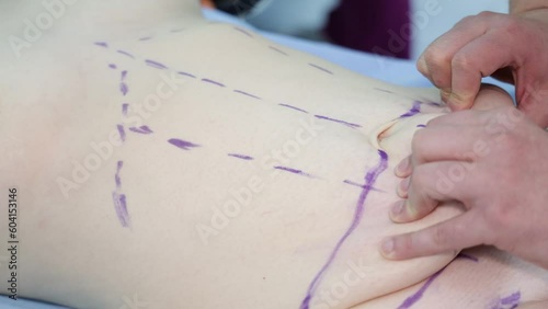 abdominoplasty correction of the abdomen with the help of surgery
