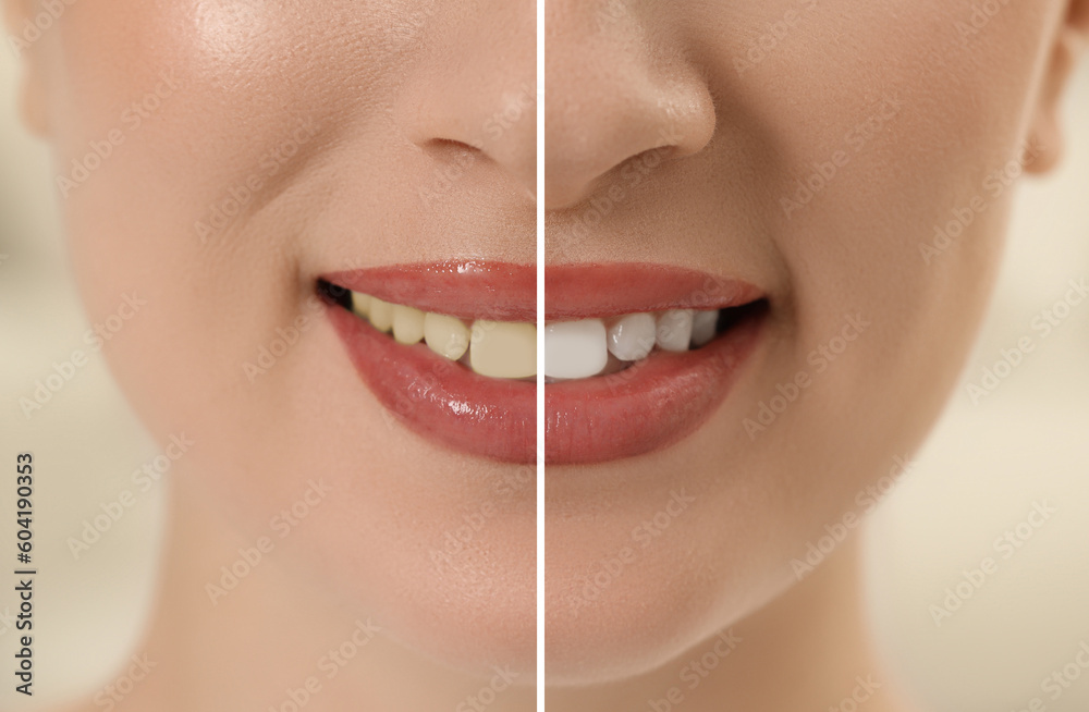 Photo of woman divided in halves before and after tooth whitening, closeup. Collage design