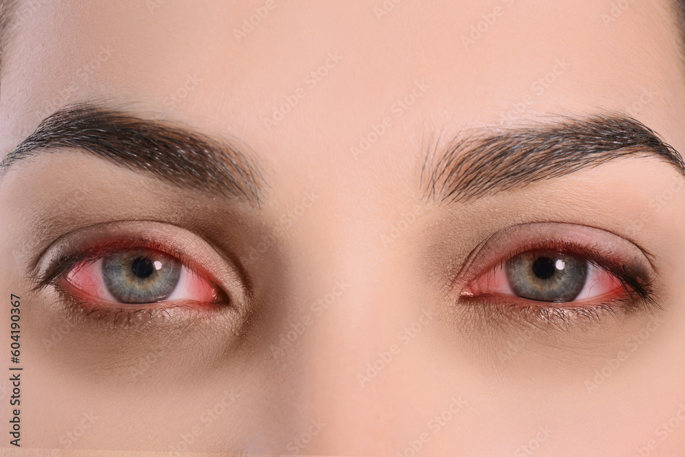 Woman with red eyes suffering from conjunctivitis, closeup Woman with red eyes suffering from conjunctivitis, closeup