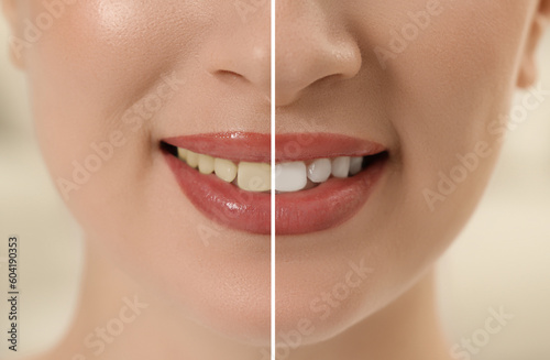 Photo of woman divided in halves before and after tooth whitening, closeup. Collage design