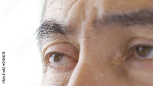 Eye disease (pterygium). photo