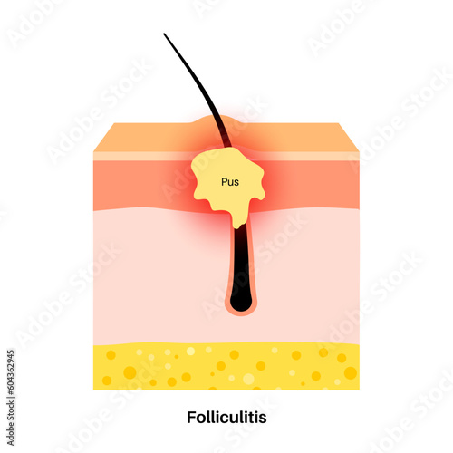 Folliculitis in skin layers