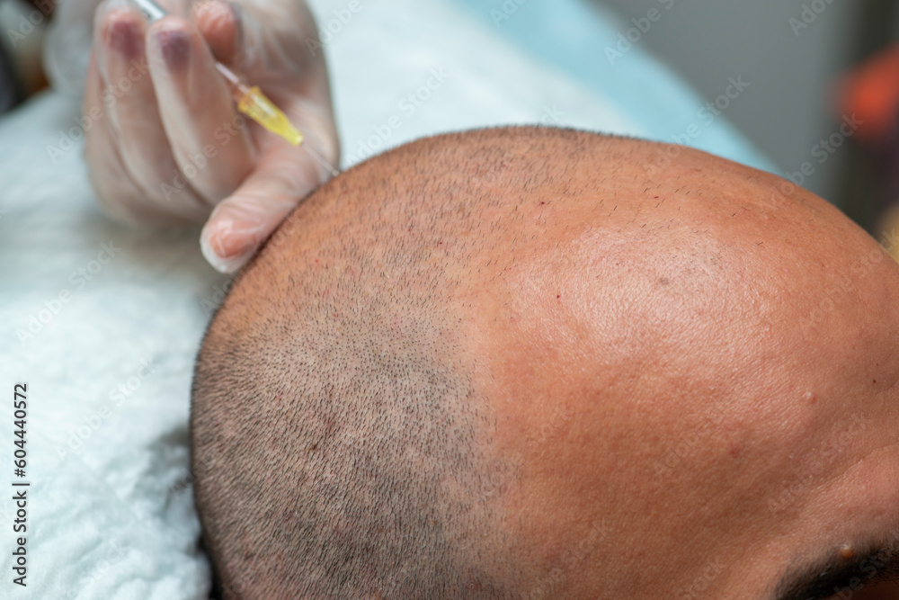 Naklejka premium Hair transplantation and PRP application. PRP application to strengthen the hair follicle.
