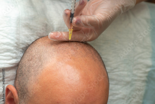 Hair transplantation and PRP application. PRP application to strengthen the hair follicle.