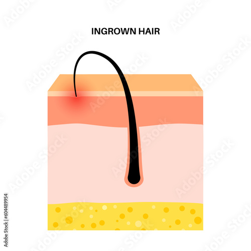 Ingrown hair inflammation