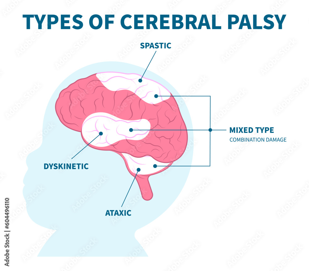 Obraz premium Triplegia in Fetal head damage or Parkinson's and bell's body disease Tremors arm leg Cerebral palsy dyskinetic diplegia quadriplegia Monoplegia Hemiplegia stiff birth motor Gene physical child Infant