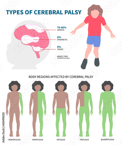 Cerebral palsy dyskinetic or diplegia quadriplegia Monoplegia Hemiplegia Triplegia of Parkinson's and bell's body Fetal Stiff damage birth motor Gene Tremors arm leg physical child Infant head
