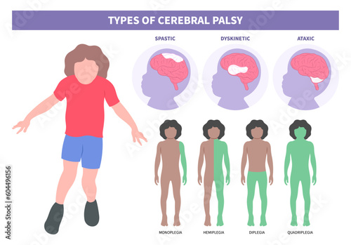 Child tremors arm leg in Monoplegia Cerebral palsy dyskinetic or diplegia quadriplegia Hemiplegia Triplegia of Parkinson's and bell's body Fetal Stiff damage birth motor Gene physical Infant head