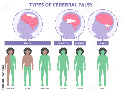 Monoplegia Child tremors arm leg in Cerebral palsy dyskinetic or diplegia quadriplegia Hemiplegia Triplegia of bell's body Fetal Stiff birth motor Gene physical Infant head and Parkinson's damage