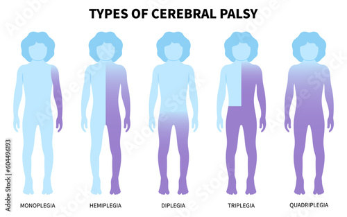 Parkinson's and bell's body disease or Cerebral palsy dyskinetic diplegia quadriplegia Monoplegia Hemiplegia Triplegia in Fetal head stiff damage birth motor Gene physical child Infant Tremors arm leg