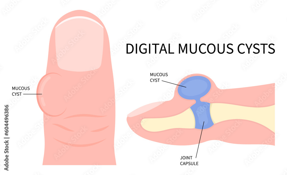Mucoid Ropes Vetor de Digital Mucous Myxoid Cyst and Needling drain osteoarthritis ...