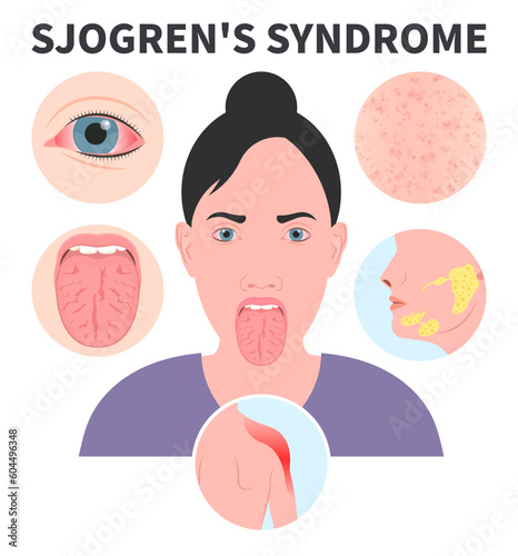 Sjogren's Syndrome dry eye Lymph nodes redness saliva sialadenitis Intraoral halitosis Burning Fissured Difficulty swallowing Fissured throat skin Cracked sore tongue