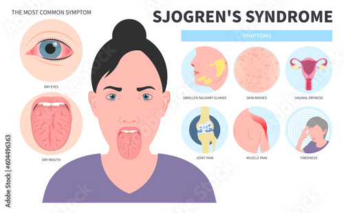 Halitosis Syndrome dry eye and Lymph nodes redness saliva with sialadenitis Intraoral of Sjogren's Burning Fissured the throat skin Cracked sore tongue Difficulty swallowing photo