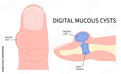 Digital Mucous Myxoid Cyst and Needling drain osteoarthritis ganglion synovial finger joint disease biopsy medical photo