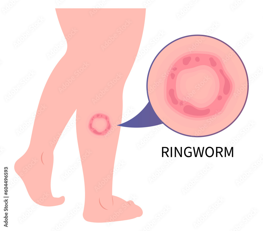 Leg skin psoriasis ringworm eczema or Jock itch fungal rash body fungus ...