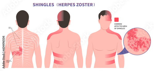 Area that the varicella chickenpox pain on body and skin itching rash Shingles Herpes Zoster virus blister sores of torso Vaccine photo