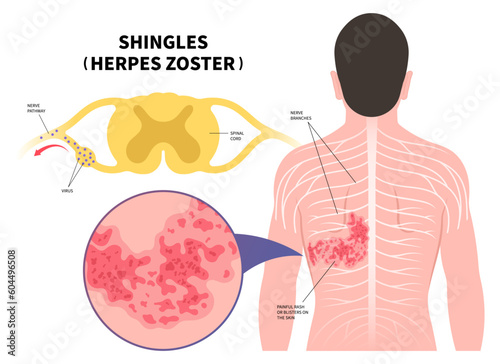 Nerve medical anatomy with Shingles Herpes Zoster virus on body and skin itching rash blister sores of varicella chickenpox pain torso Vaccine