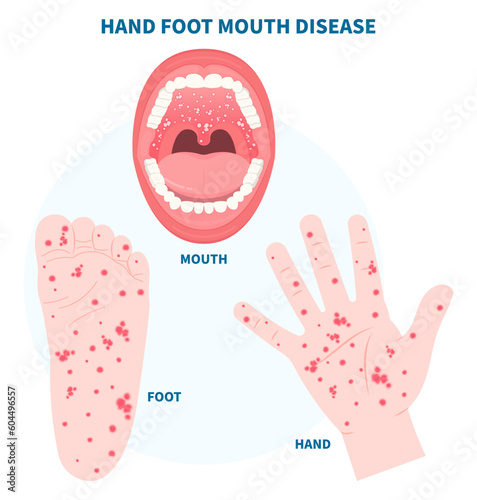 Coxsackie virus infection in mouth throat disease with Herpangina hand foot herpes strep stomatitis canker sore enteroviruses photo