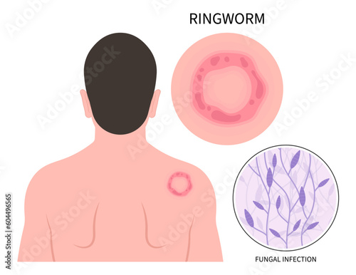 body skin fungal rash in hand with ringworm eczema psoriasis or Jock itch leg fungus tinea cruris dermatophytosis Itchiness Scaly athlete's circular excessive infection photo