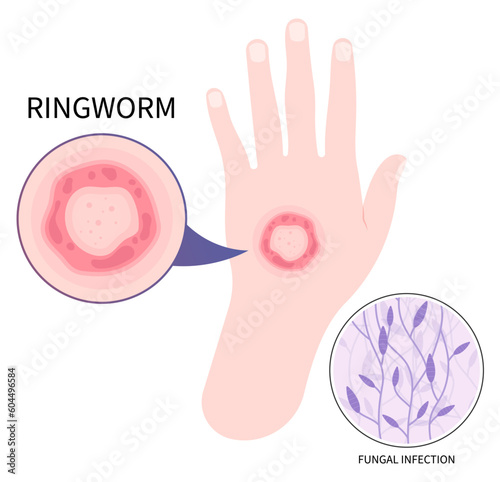 Hand with ringworm eczema psoriasis or Jock itch skin fungal rash body leg fungus tinea cruris dermatophytosis Itchiness Scaly athlete's circular excessive infection