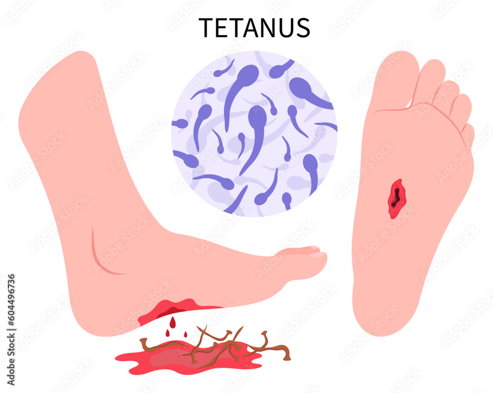 Foot Injury With Tetanus Infection Bacteria Clostridium Tetani Virus foot-injury-with-tetanus-infection-bacteria-clostridium-tetani-virus