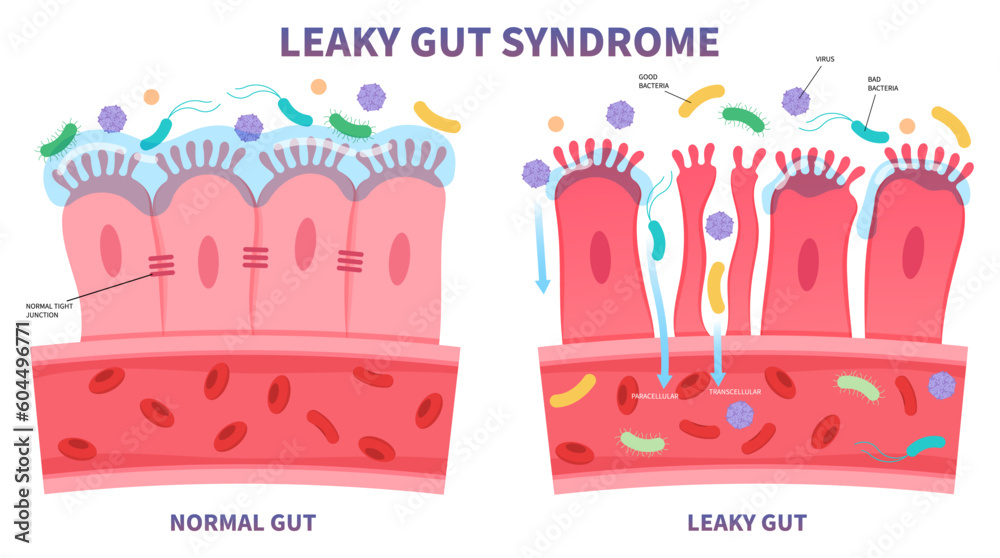 leaky gut syndrome celiac disease pain of food immune with IBS and IBD Irritable bowel Inflammatory system upper tract peptic ulcer Small intestinal bacterial overgrowth gluten psoriasis medical - obrazy, fototapety, plakaty 