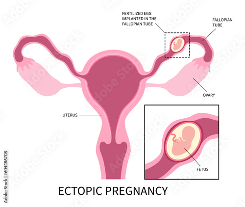 Ectopic pregnancy abortion miscarriage blighted ovum fallopian tube and In vitro Fertilisation ovaries womb fertilized photo