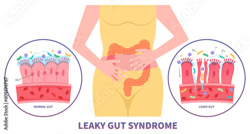 intestinal bacterial overgrowth leaky gut syndrome celiac disease pain of food immune Inflammatory system upper tract Small gluten psoriasis with IBS and IBD Irritable bowel medical peptic ulcer photo