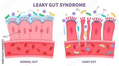 leaky gut syndrome celiac disease pain of food immune with IBS and IBD Irritable bowel Inflammatory system upper tract peptic ulcer Small intestinal bacterial overgrowth gluten psoriasis medical