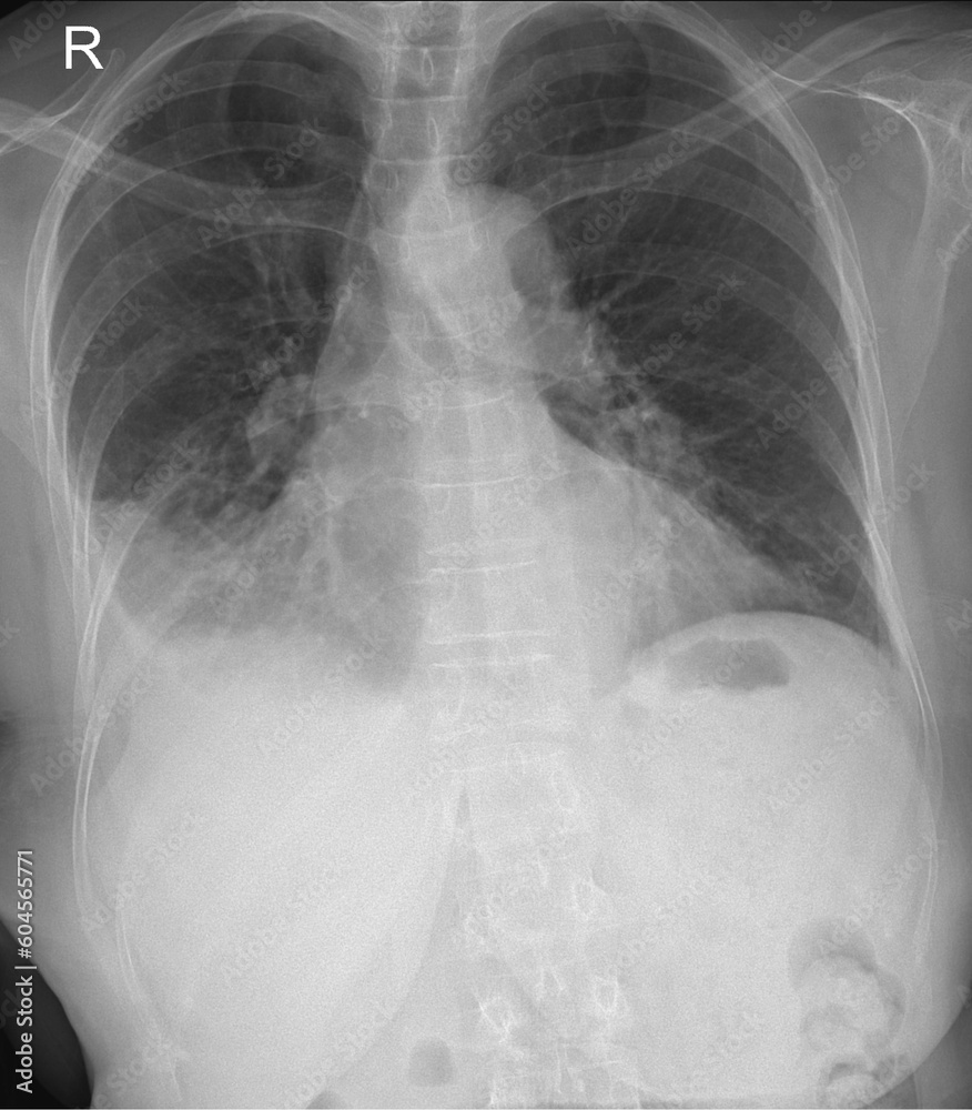 radiography of the human heart