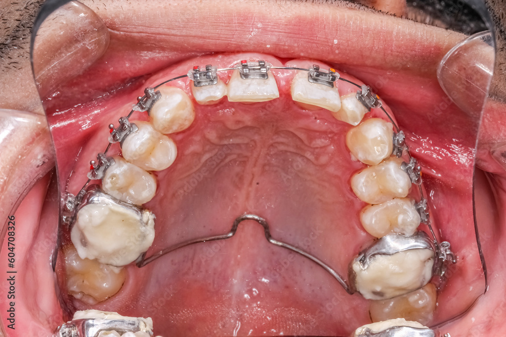 Stockfoto Dental orthodontics braces with colored dots, NiTi palatal
