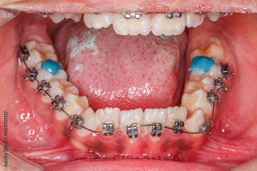 Dental orthodontic braces for orthodontics teeth alignment with white