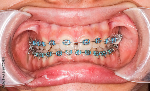 Dental orthodontic braces with blue colored elastic ligatures. Orthodontics teeth alignment treatment patient case with anterior diastema gap between central incisors. Macro-photography close-up.