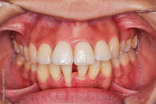Fotografiet Front view of dental arches in occlusion, lips and cheeks retracted with cheek retractor