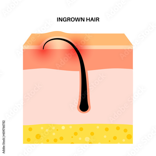 Ingrown hair inflammation